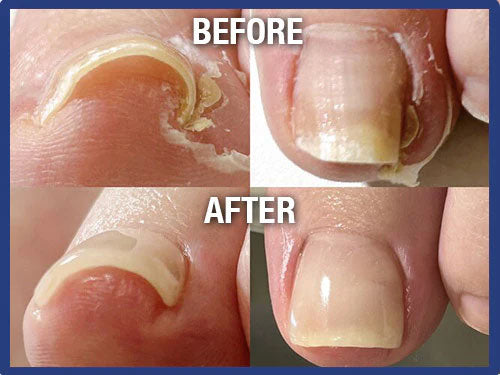 Reparerande nagelserum