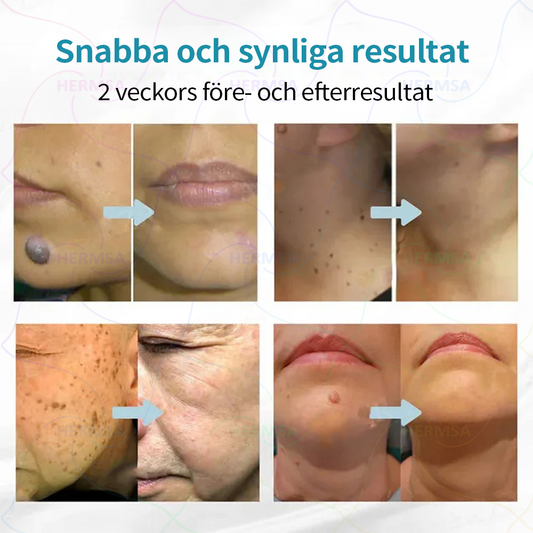 Hermsa® icke-invasiv laserpekare - borttagning av födelsemärken och vårtor (🔥Sista dagen 80% rabatt)